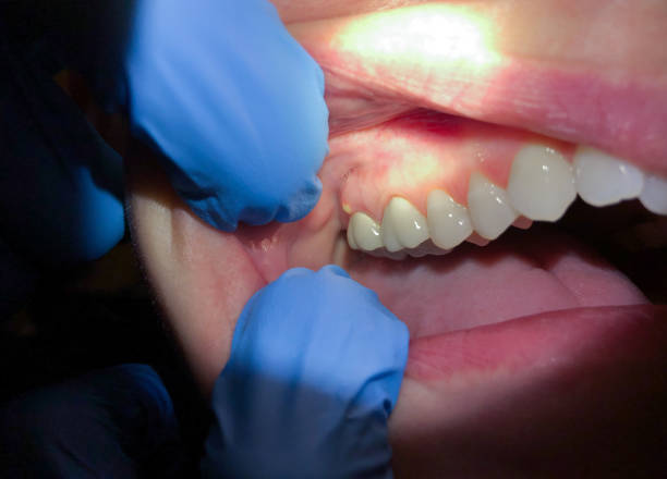 Best Chipped Tooth Repair Near Me  in Pleasant Hill, TX